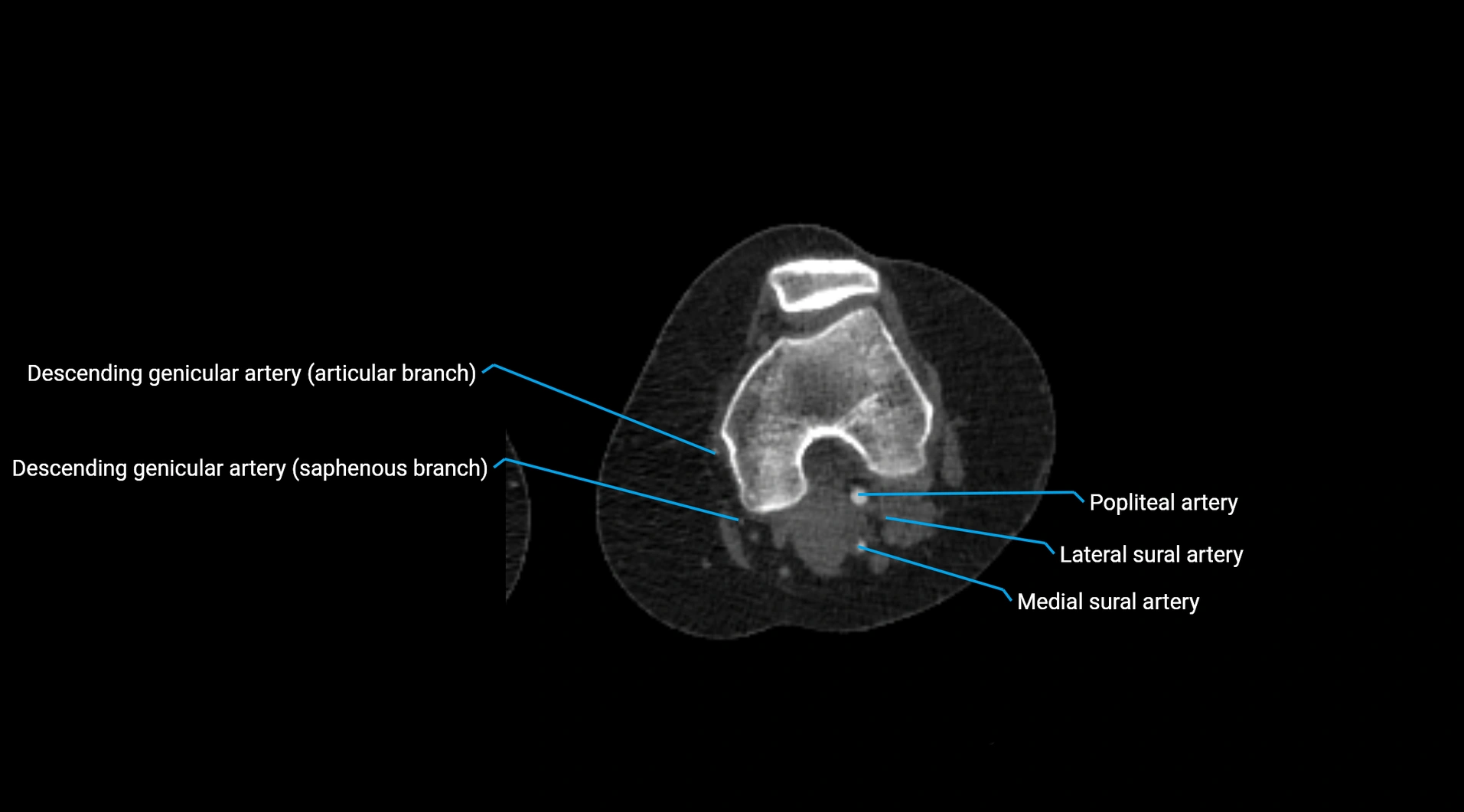 CTA lower limb cross sectional anatomy labelled image _171.webp